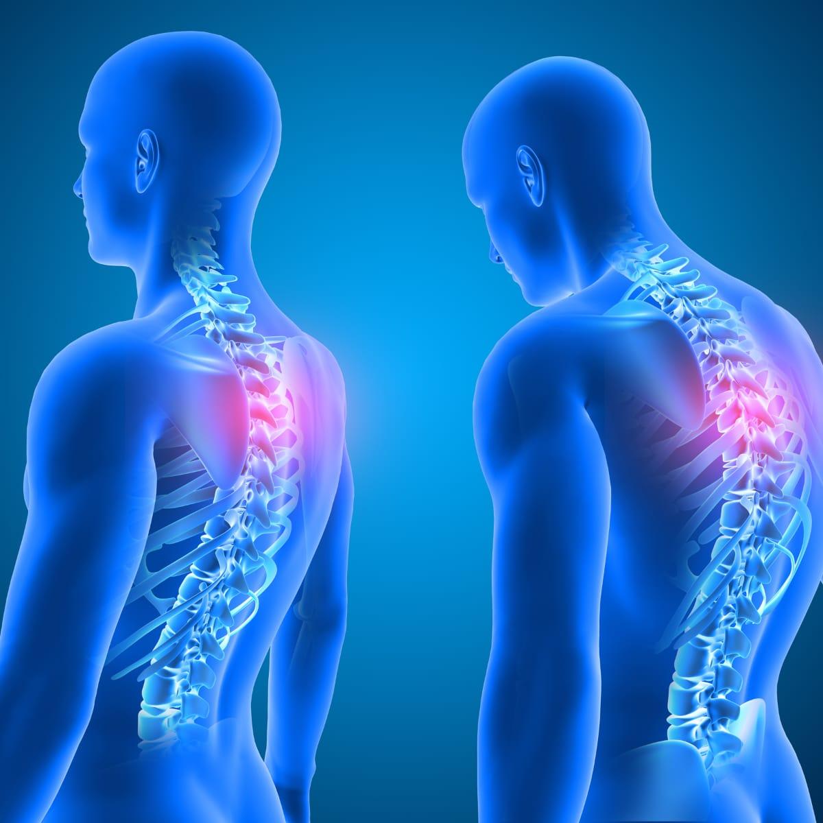 An illustration of two human figures with visible spines, one upright and one with the head and shoulders slumped forward